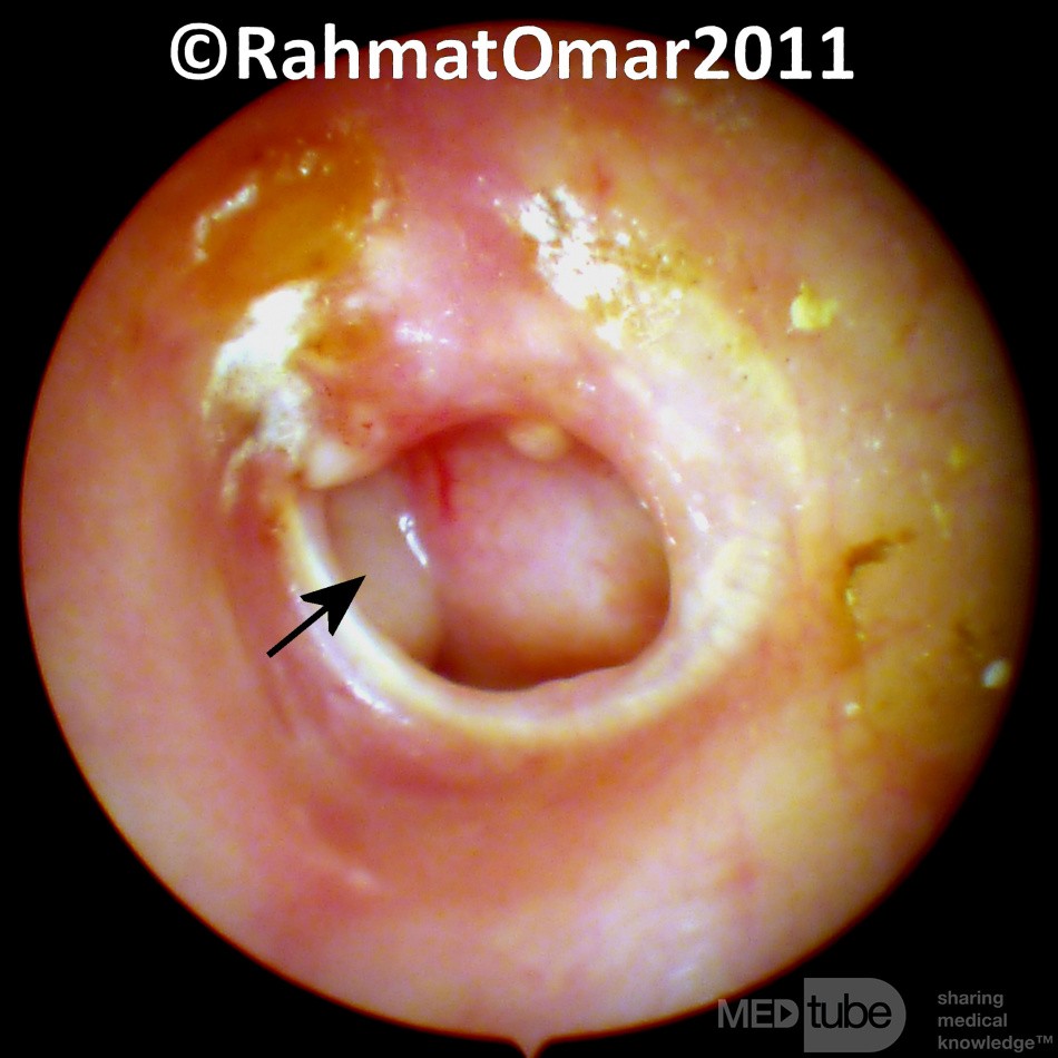 Chronic Suppurative Otitis Media: Active Stage