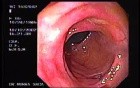 Diverticulitis - Endoscopy