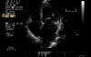 Flail Mitral Valve with Severe Mitral Regurgitation