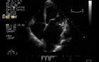 Flail Mitral Valve with Severe Mitral Regurgitation