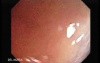Huge Mass Of The Descending Colon (17 of 25)