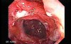 Multiple Adenomatous Polyps Of The Rectum (19 of 37)