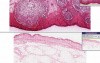 Furuncle (abscess)