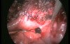 How Important Is Suturing in Dealing With Complications Caused by Laparoscopic Surgery?