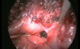 How Important Is Suturing in Dealing With Complications Caused by Laparoscopic Surgery?