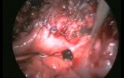 How Important Is Suturing in Dealing With Complications Caused by Laparoscopic Surgery?