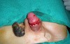 Penis Injury  Necrotic Tissue Removed