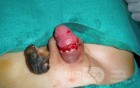 Penis Injury  Necrotic Tissue Removed