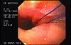 Flexible Endoscopic Suturing - Visualization of Threads