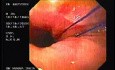 Flexible Endoscopic Suturing - Visualization of Threads