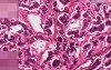 Bronchial carcinoid - Histopathology - Lung