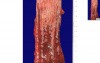 Barrett Esophagus