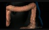 Colonoscopy