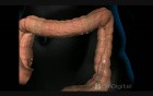 Colonoscopy