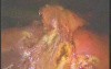 Laparoscopic Cholecystectomy - Part 2