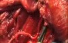 The Trotter Procedure