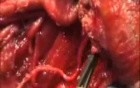 The Trotter Procedure