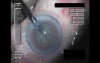Cataract Surgery XII - Part 2