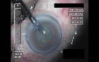 Cataract Surgery XII - Part 2