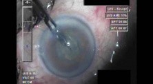 Cataract Surgery XII - Part 2