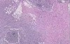 Actinomycosis diverticulitis, abscess