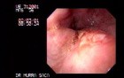 Ulcerative Adenocarcinoma of the Gasrtic Fudnus And Cardias