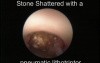 Endoscopic Lithotripsy Procedure