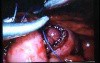 Jejunal Gastrointestinal Stromal tumor (GIST) (72 of 86)