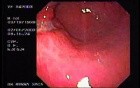 Gastric Ulcer with Irregular Borders - 63 Years-Old Male