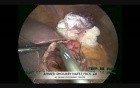 Laparoscopic Cystogastrostomy For Pancreatic Pseudocyst