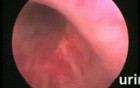 Stone In The Urinary Bladder - Endoscopic View