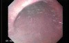 Watermelon Stomach (7 of 7) - Treatment with Argon Plasma Coagulator (APC)