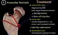 Common causes of Hip Pain - Video Lecture