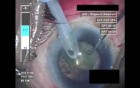 Cataract Surgery X - Part 3