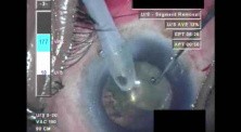 Cataract Surgery X - Part 3