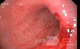 Endoscopy - Active Chronic Gastropathy