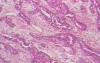 Barrett Adenocarcinoma - Endoscopic Image  (5 of 20)