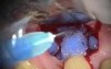 Root Resorption Repair