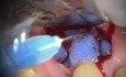 Root Resorption Repair
