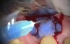 Root Resorption Repair