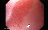 Duodenal Ulcer (3 of 4)