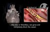 Atherosclerosis