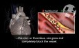 Atherosclerosis