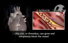 Atherosclerosis