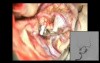 Middle Cerebral Artery (MCA) Aneurysm