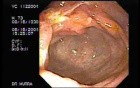 Crohn´s Disease of the Ileocecal Valve and Terminal Ileum (4 of 5)