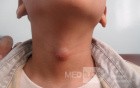 Thyroglossal Cyst