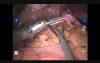 Robot Assisted Hiatoplasty after previous Sleeve Gastrectomy  
