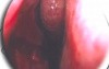 Septoplasty - Endoscopy - Updated