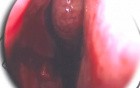 Septoplasty - Endoscopy - Updated